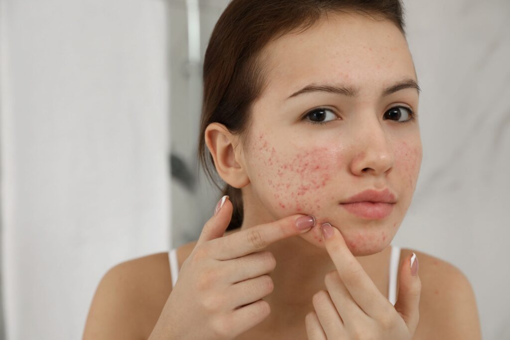 Acne-treatment