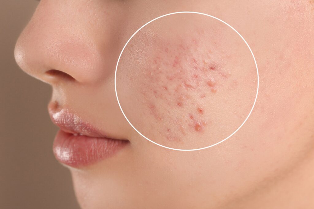 Acne-treatment-in-mumbai