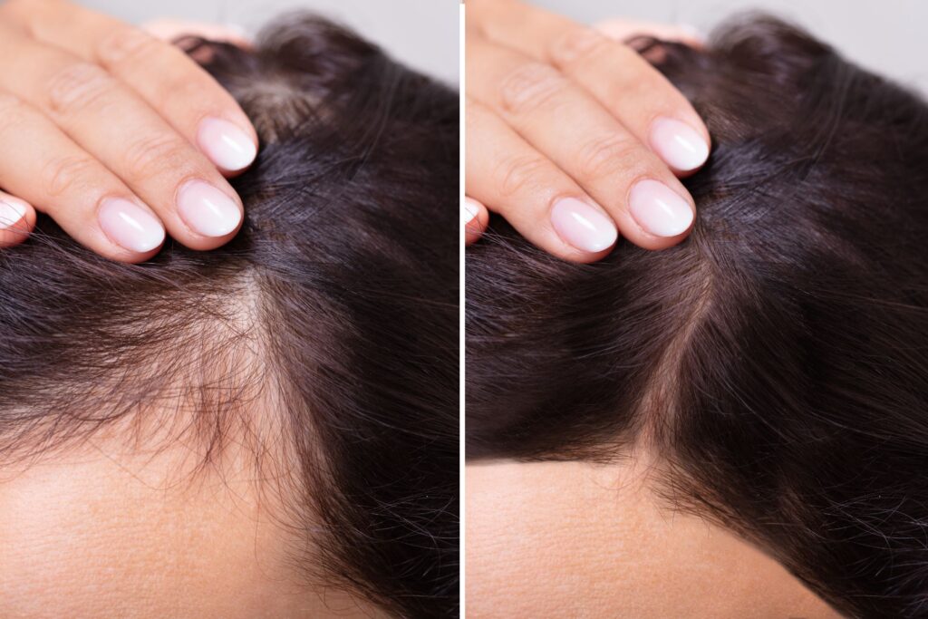 Hair Fall Treatment in Mumbai