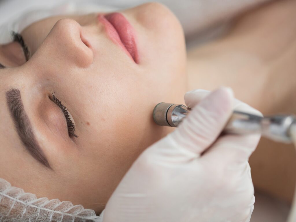 Microdermabrasion-Treatment